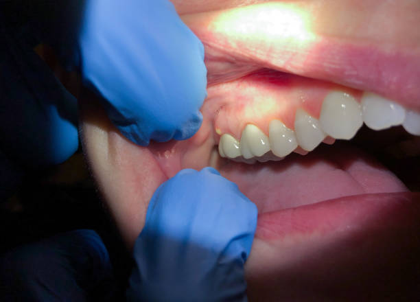 Best Knocked-Out Tooth (Avulsed Tooth) Treatment in Mount Hope, WV